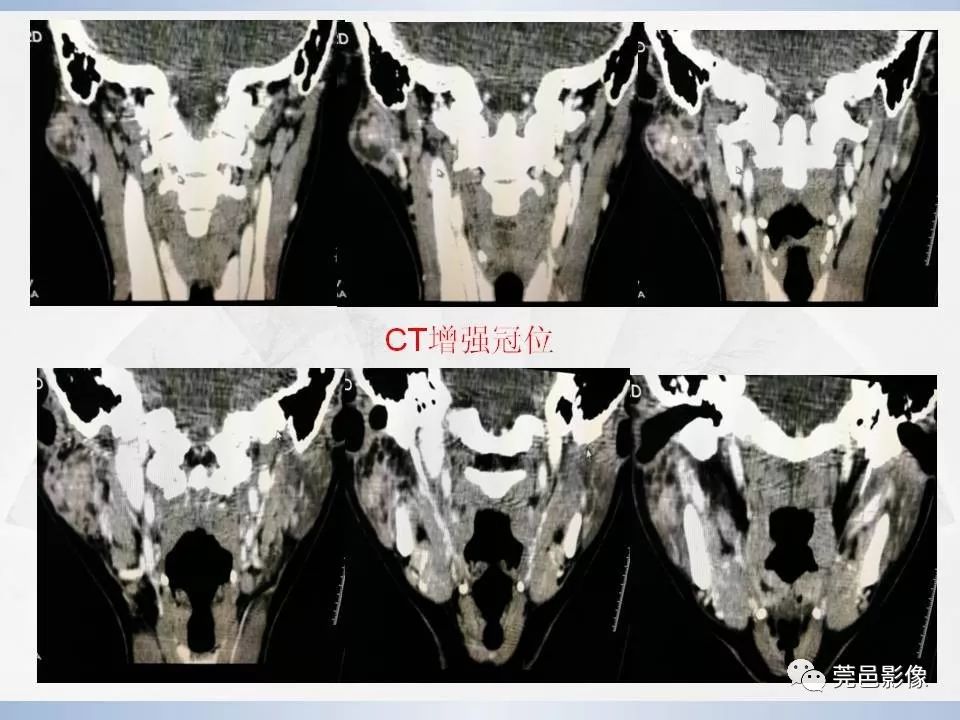 影像PPT - 【PPT】腮腺黏液表皮样癌的CT诊断与鉴别诊断-11