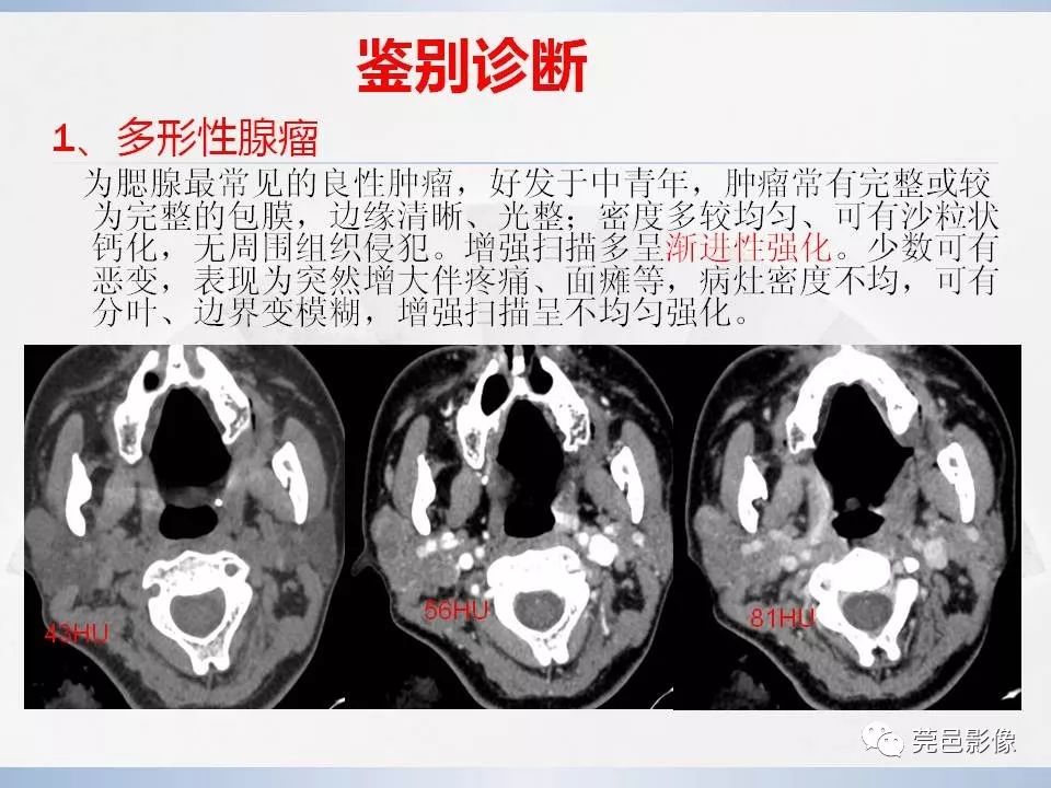 影像PPT - 【PPT】腮腺黏液表皮样癌的CT诊断与鉴别诊断-19