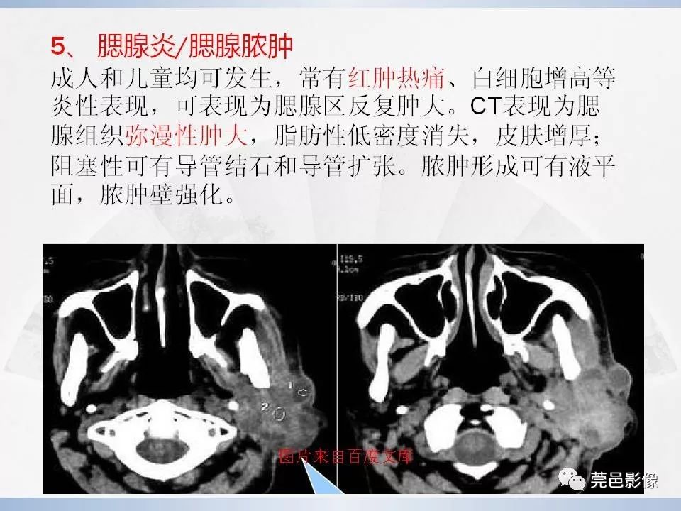 影像PPT - 【PPT】腮腺黏液表皮样癌的CT诊断与鉴别诊断-23