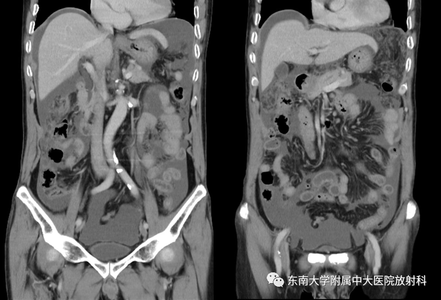 影像PPT - 【PPT】结核性腹膜炎-2