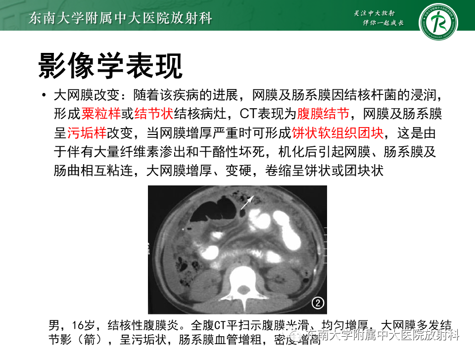 影像PPT - 【PPT】结核性腹膜炎-12