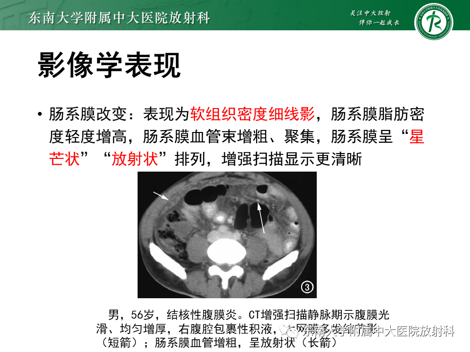 影像PPT - 【PPT】结核性腹膜炎-13