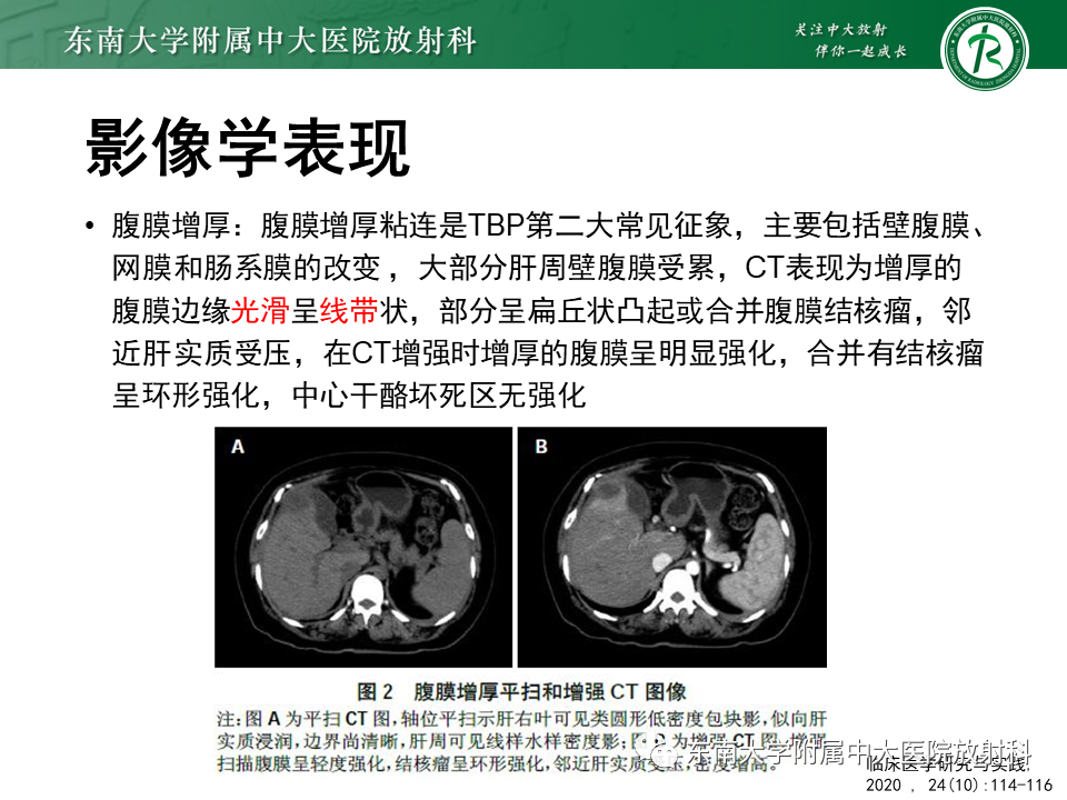 影像PPT - 【PPT】结核性腹膜炎-11