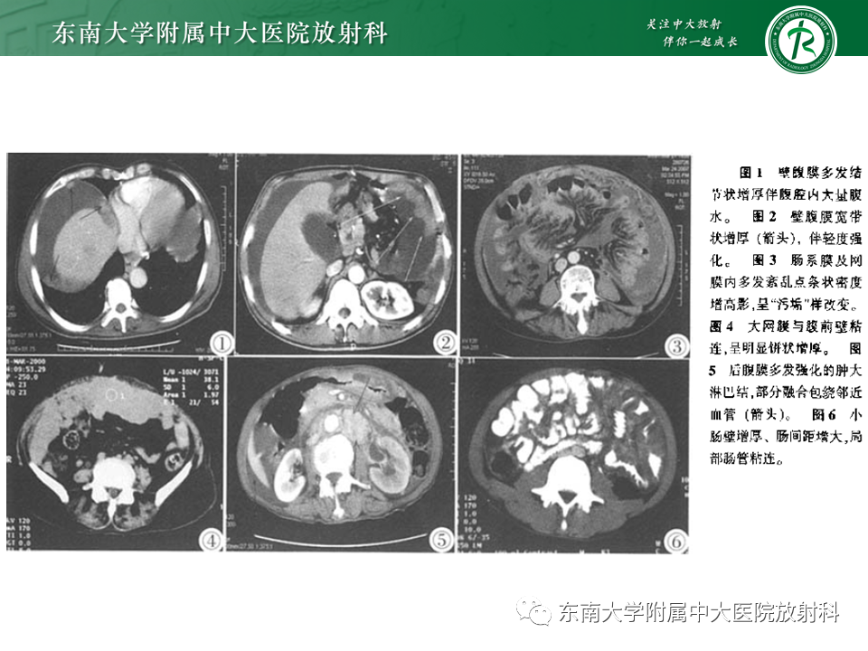 影像PPT - 【PPT】结核性腹膜炎-17