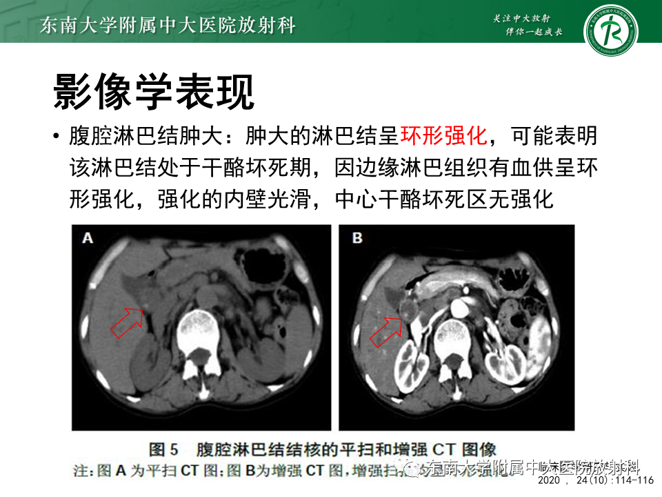 影像PPT - 【PPT】结核性腹膜炎-14