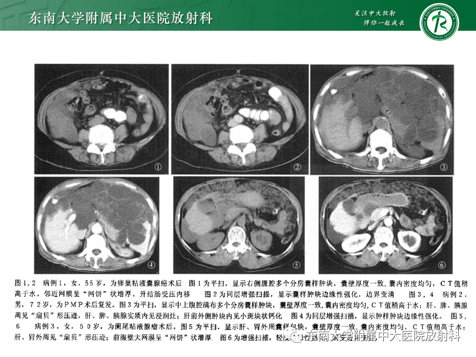 影像PPT - 【PPT】结核性腹膜炎-23