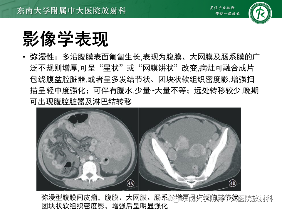 影像PPT - 【PPT】结核性腹膜炎-20