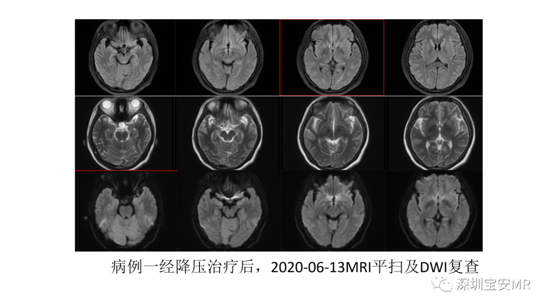 影像PPT - 【PPT】可逆性后部脑病综合征-10