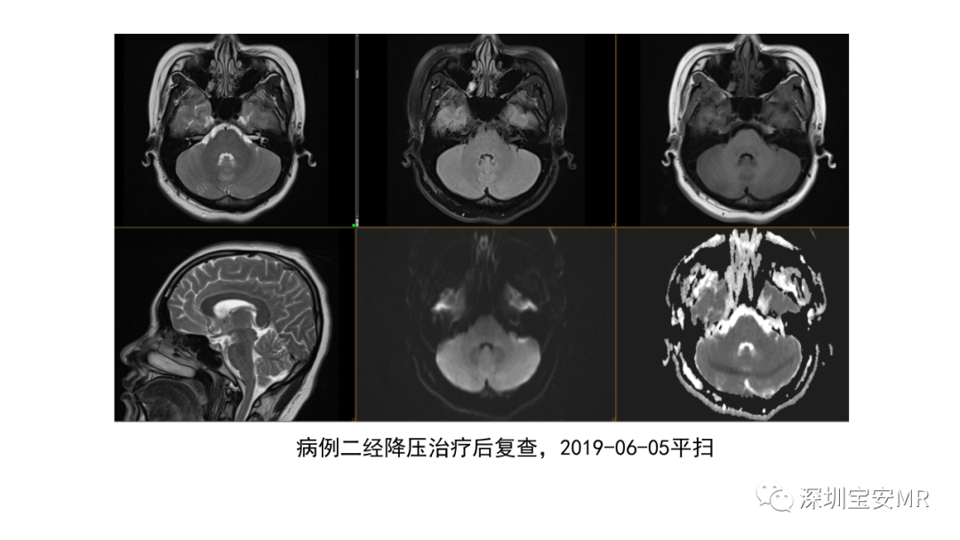 影像PPT - 【PPT】可逆性后部脑病综合征-15
