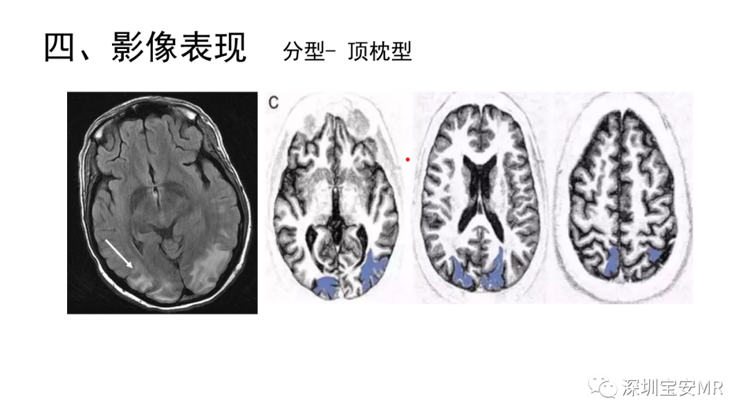影像PPT - 【PPT】可逆性后部脑病综合征-24