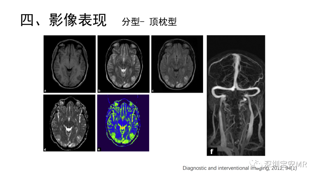 影像PPT - 【PPT】可逆性后部脑病综合征-25