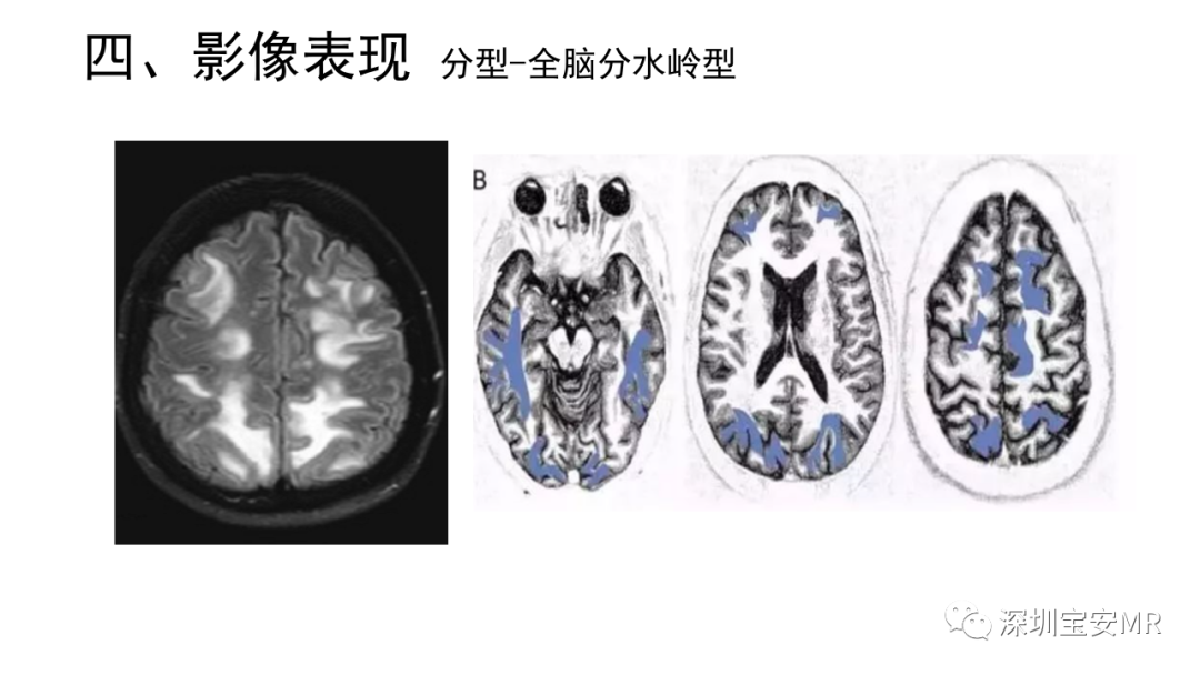 影像PPT - 【PPT】可逆性后部脑病综合征-26