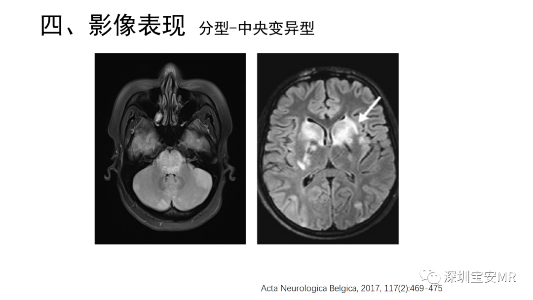 影像PPT - 【PPT】可逆性后部脑病综合征-29