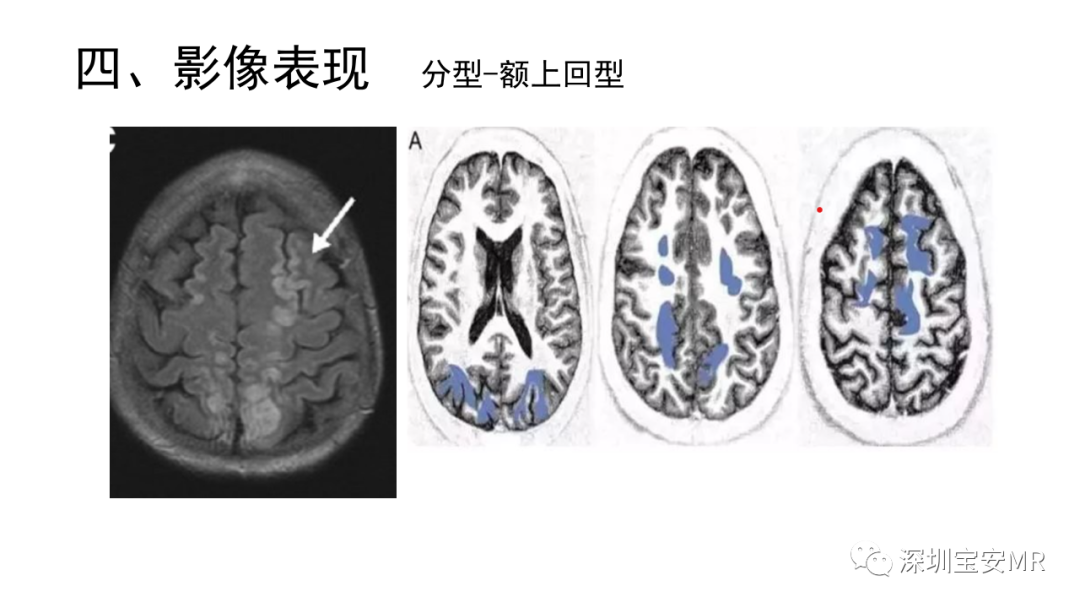 影像PPT - 【PPT】可逆性后部脑病综合征-27