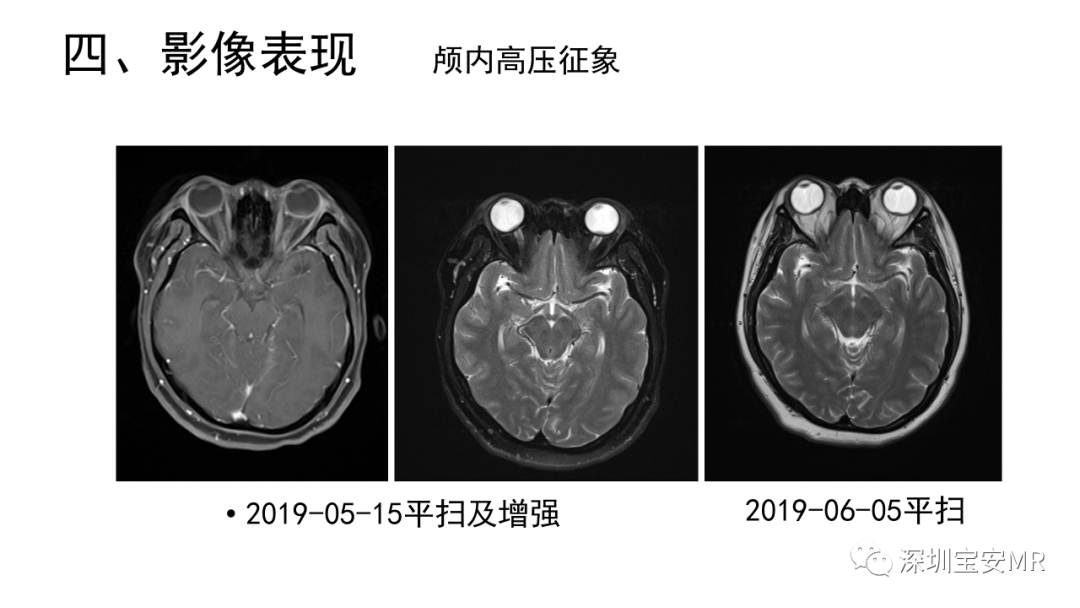 影像PPT - 【PPT】可逆性后部脑病综合征-41