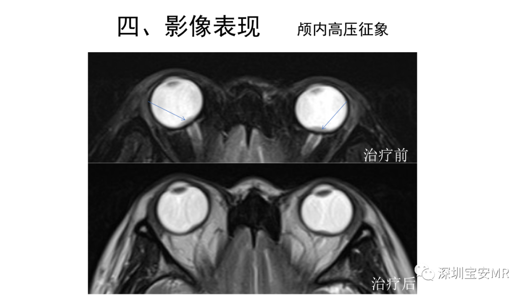 影像PPT - 【PPT】可逆性后部脑病综合征-42