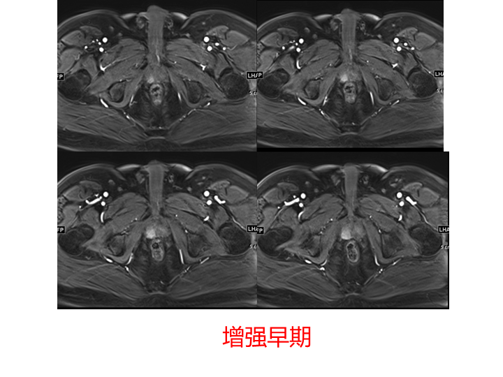 影像PPT - 【PPT】前列腺影像报告和数据系统-18