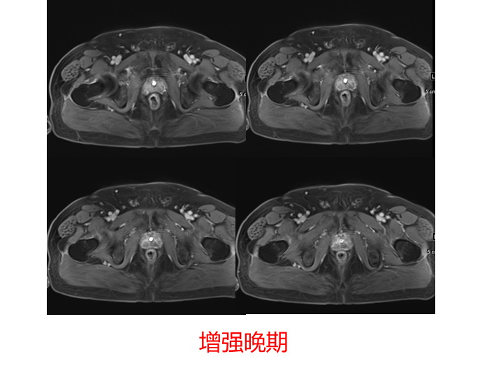 影像PPT - 【PPT】前列腺影像报告和数据系统-19