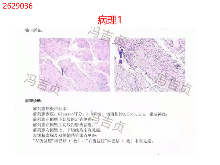 影像PPT - 【PPT】前列腺影像报告和数据系统-22