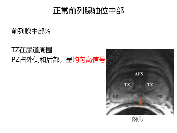 影像PPT - 【PPT】前列腺影像报告和数据系统-30
