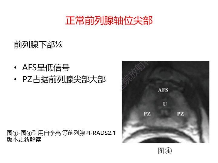 影像PPT - 【PPT】前列腺影像报告和数据系统-31