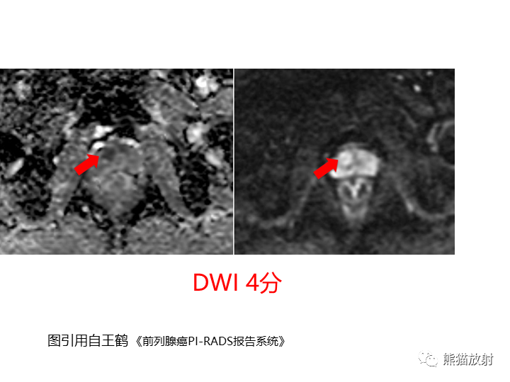 影像PPT - 【PPT】前列腺影像报告和数据系统-48