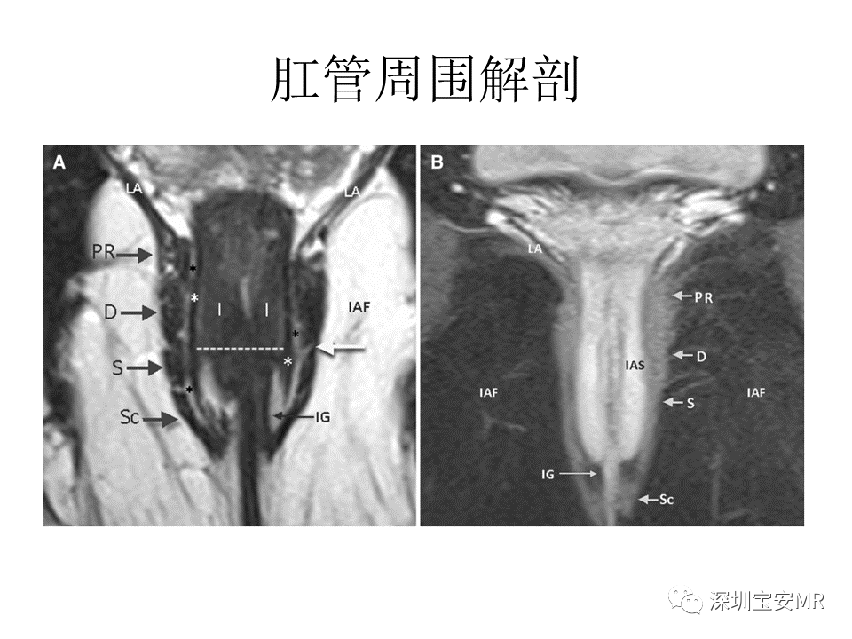 影像PPT - 【PPT】肛瘘MRI诊断-9