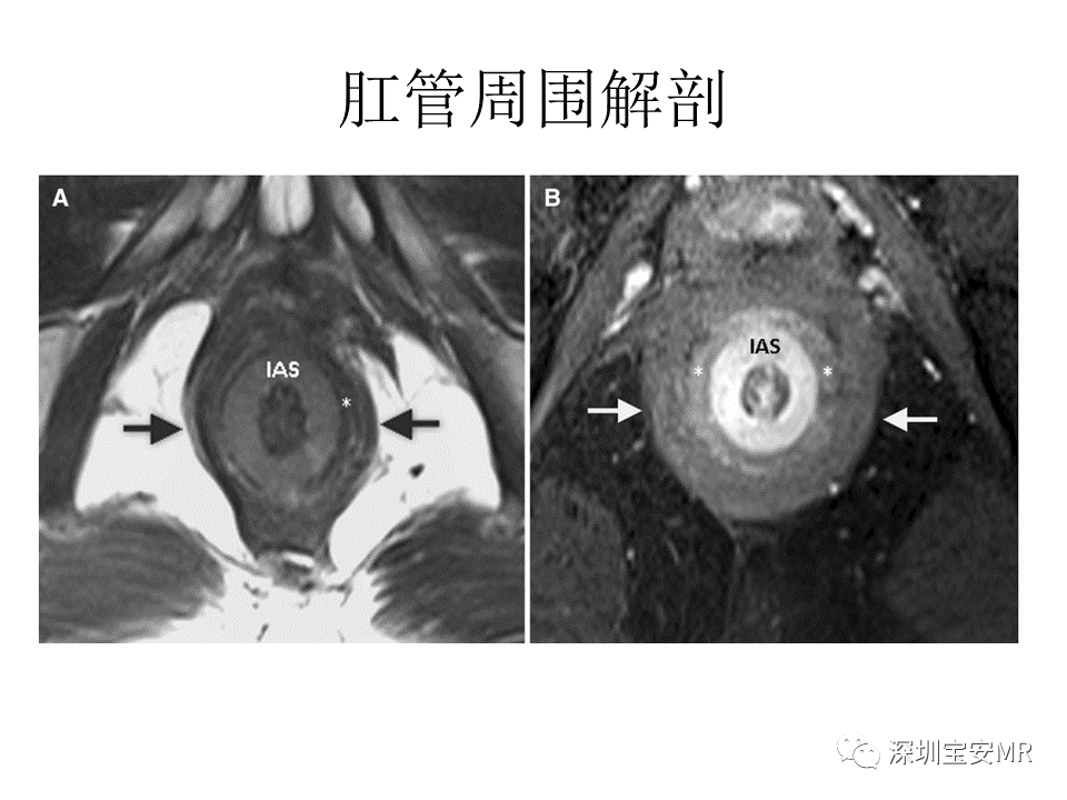 影像PPT - 【PPT】肛瘘MRI诊断-10