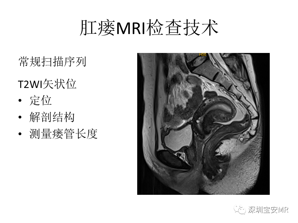 影像PPT - 【PPT】肛瘘MRI诊断-13
