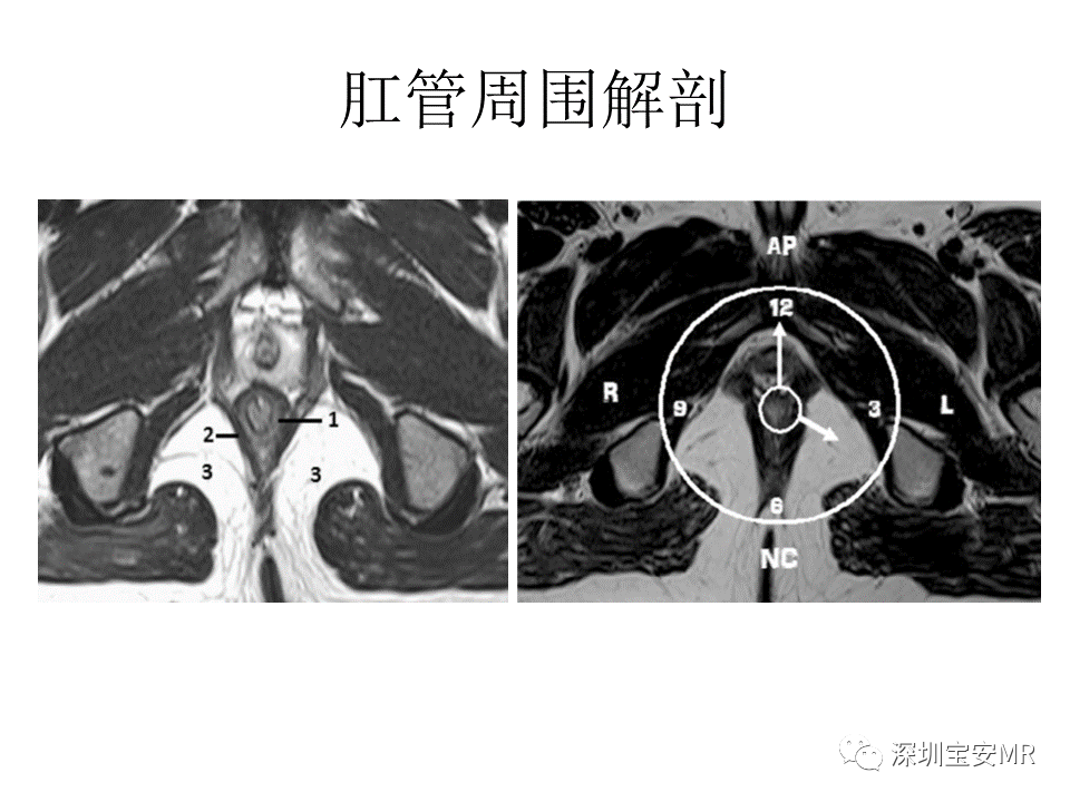 影像PPT - 【PPT】肛瘘MRI诊断-11