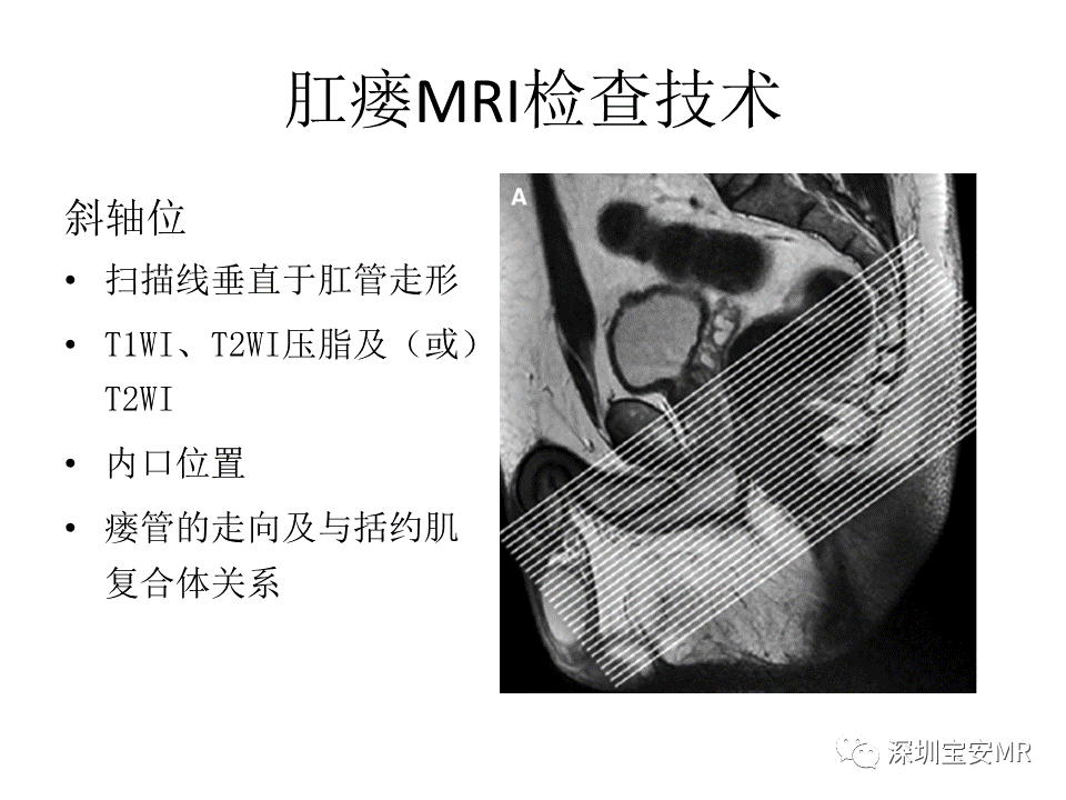 影像PPT - 【PPT】肛瘘MRI诊断-14