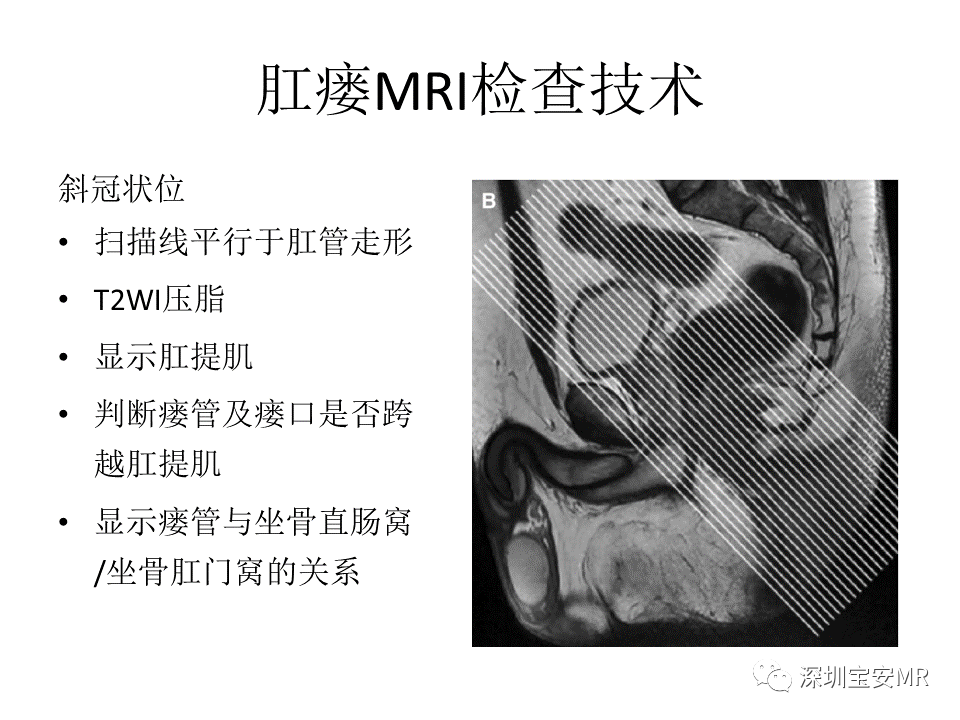 影像PPT - 【PPT】肛瘘MRI诊断-15