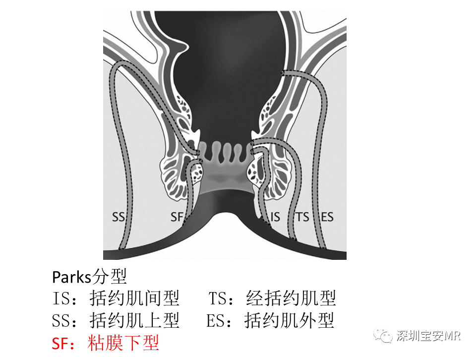 影像PPT - 【PPT】肛瘘MRI诊断-21