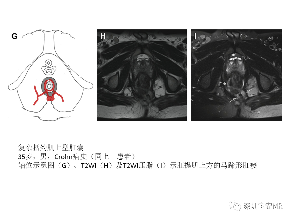 影像PPT - 【PPT】肛瘘MRI诊断-25