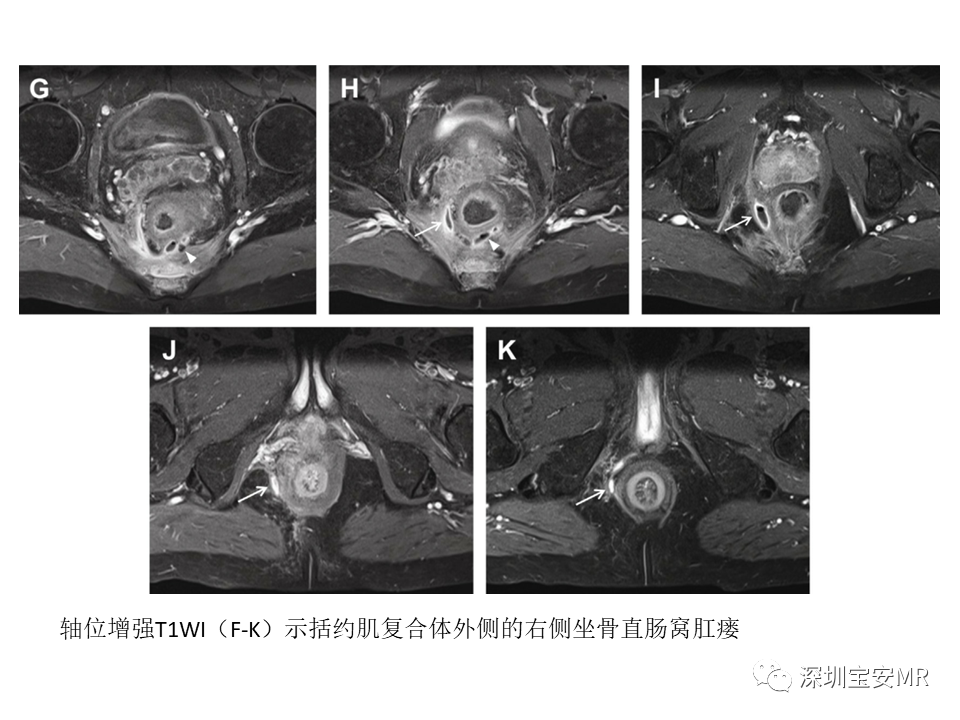 影像PPT - 【PPT】肛瘘MRI诊断-27