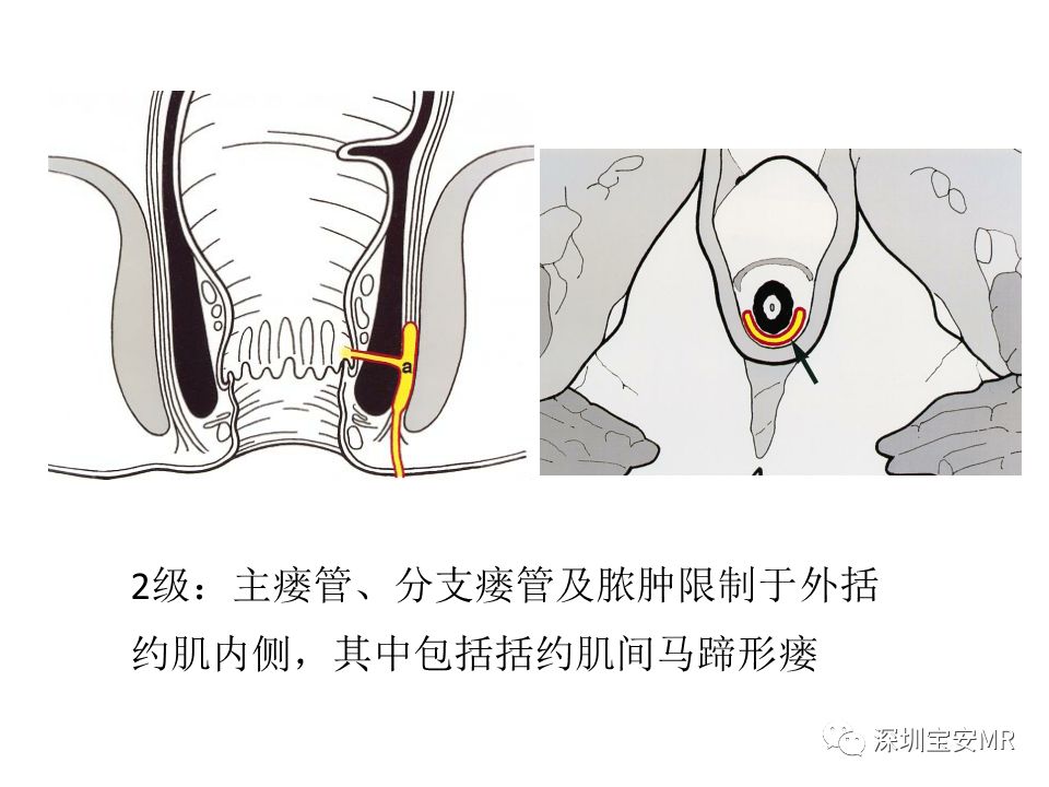 影像PPT - 【PPT】肛瘘MRI诊断-31