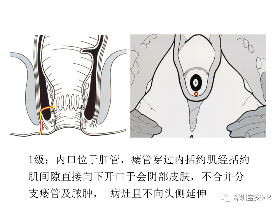 影像PPT - 【PPT】肛瘘MRI诊断-29