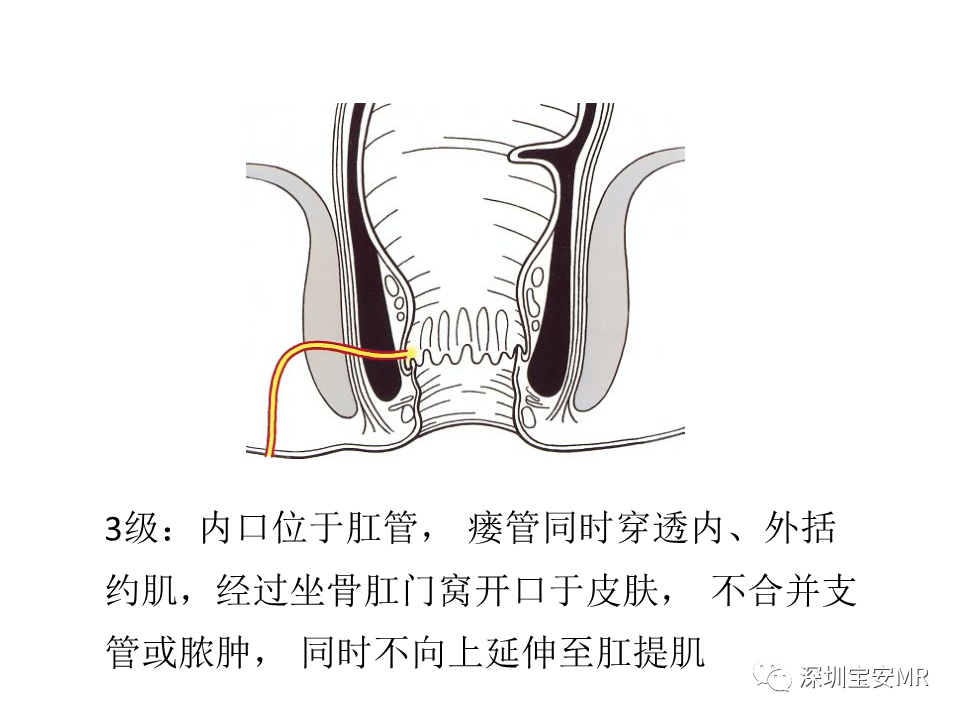 影像PPT - 【PPT】肛瘘MRI诊断-33