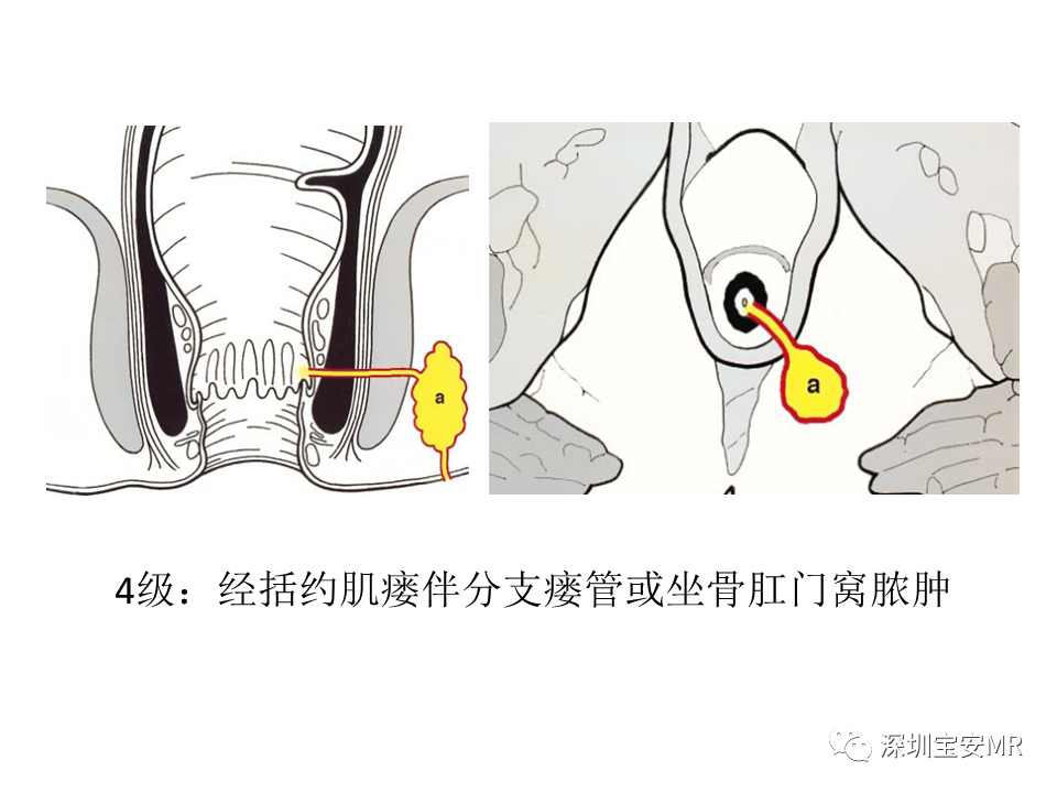 影像PPT - 【PPT】肛瘘MRI诊断-36
