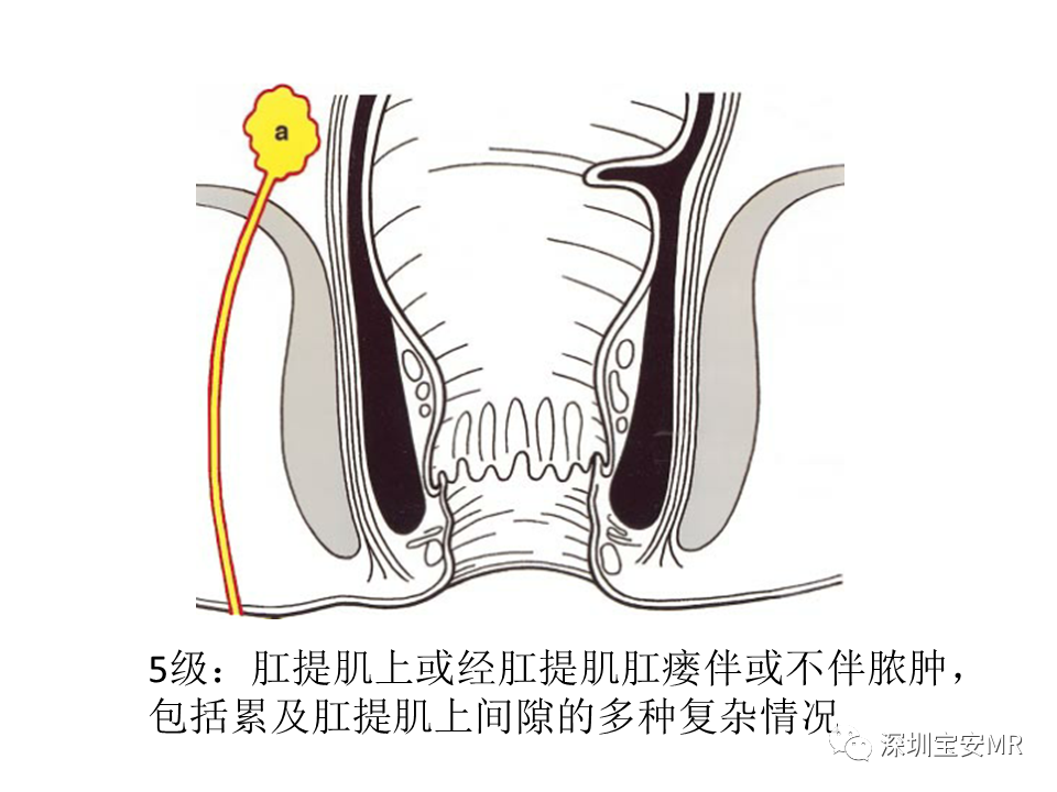 影像PPT - 【PPT】肛瘘MRI诊断-39