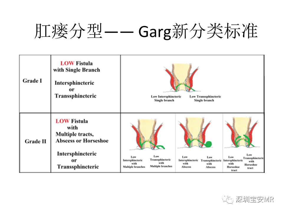 影像PPT - 【PPT】肛瘘MRI诊断-42