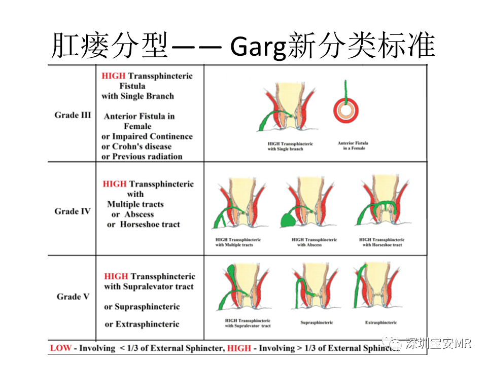 影像PPT - 【PPT】肛瘘MRI诊断-43