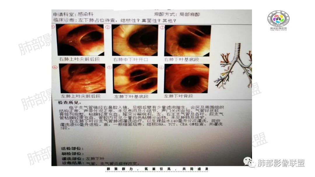 影像PPT - 【病例】 道貌岸然的肺腺癌-5 影像PPT - 【病例】 道貌岸然的肺腺癌-5