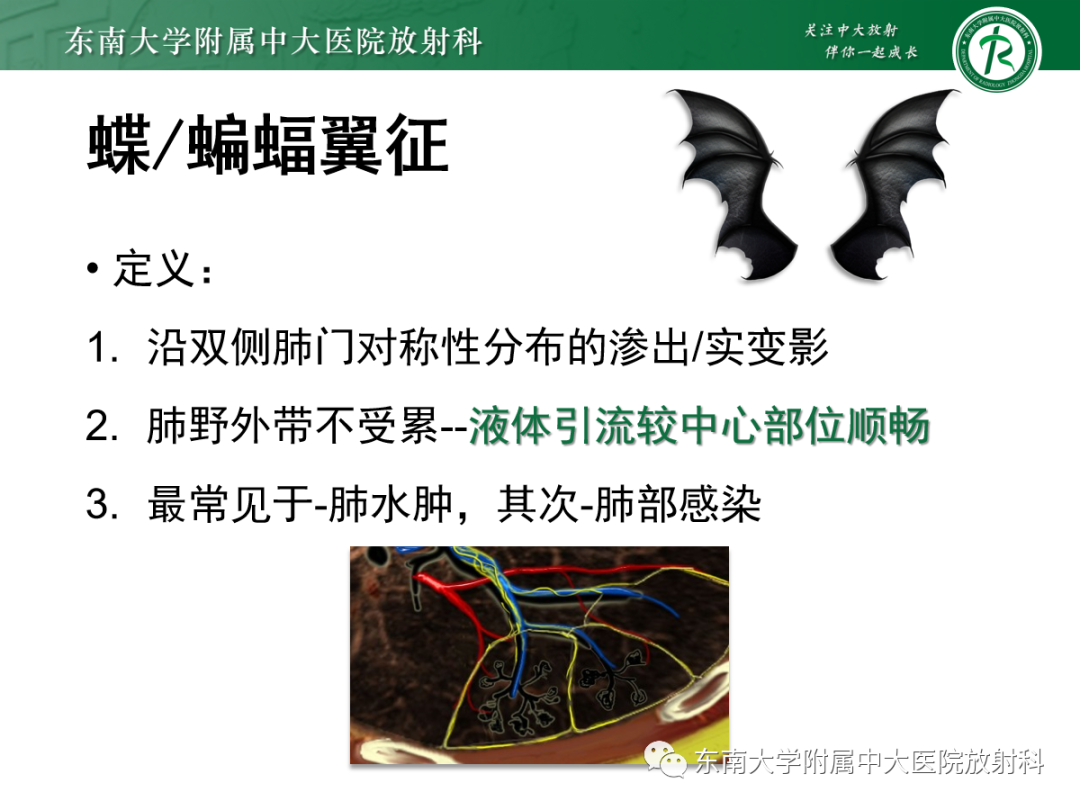 影像PPT - 【PPT】蝶翼征—耶氏肺孢子菌肺炎 VS 急性心源性肺水肿-10 影像PPT - 【PPT】蝶翼征—耶氏肺孢子菌肺炎 VS 急性心源性肺水肿-10