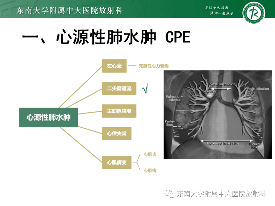影像PPT - 【PPT】蝶翼征—耶氏肺孢子菌肺炎 VS 急性心源性肺水肿-13 影像PPT - 【PPT】蝶翼征—耶氏肺孢子菌肺炎 VS 急性心源性肺水肿-13