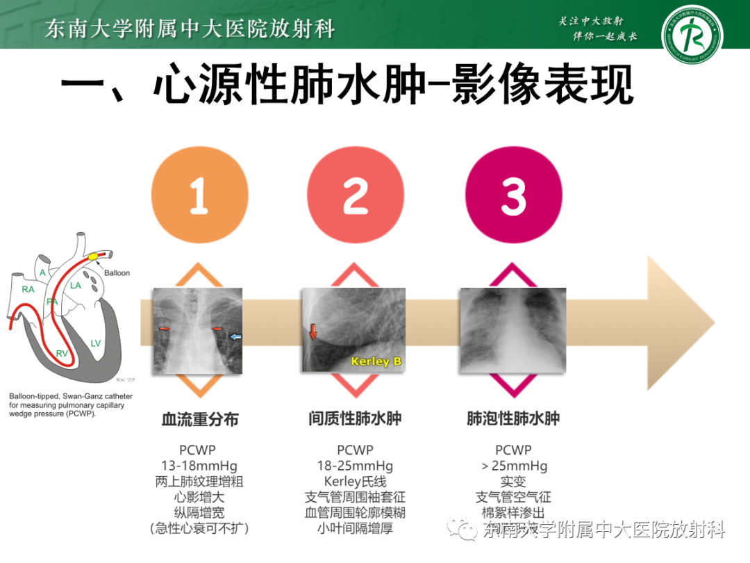 影像PPT - 【PPT】蝶翼征—耶氏肺孢子菌肺炎 VS 急性心源性肺水肿-14 影像PPT - 【PPT】蝶翼征—耶氏肺孢子菌肺炎 VS 急性心源性肺水肿-14