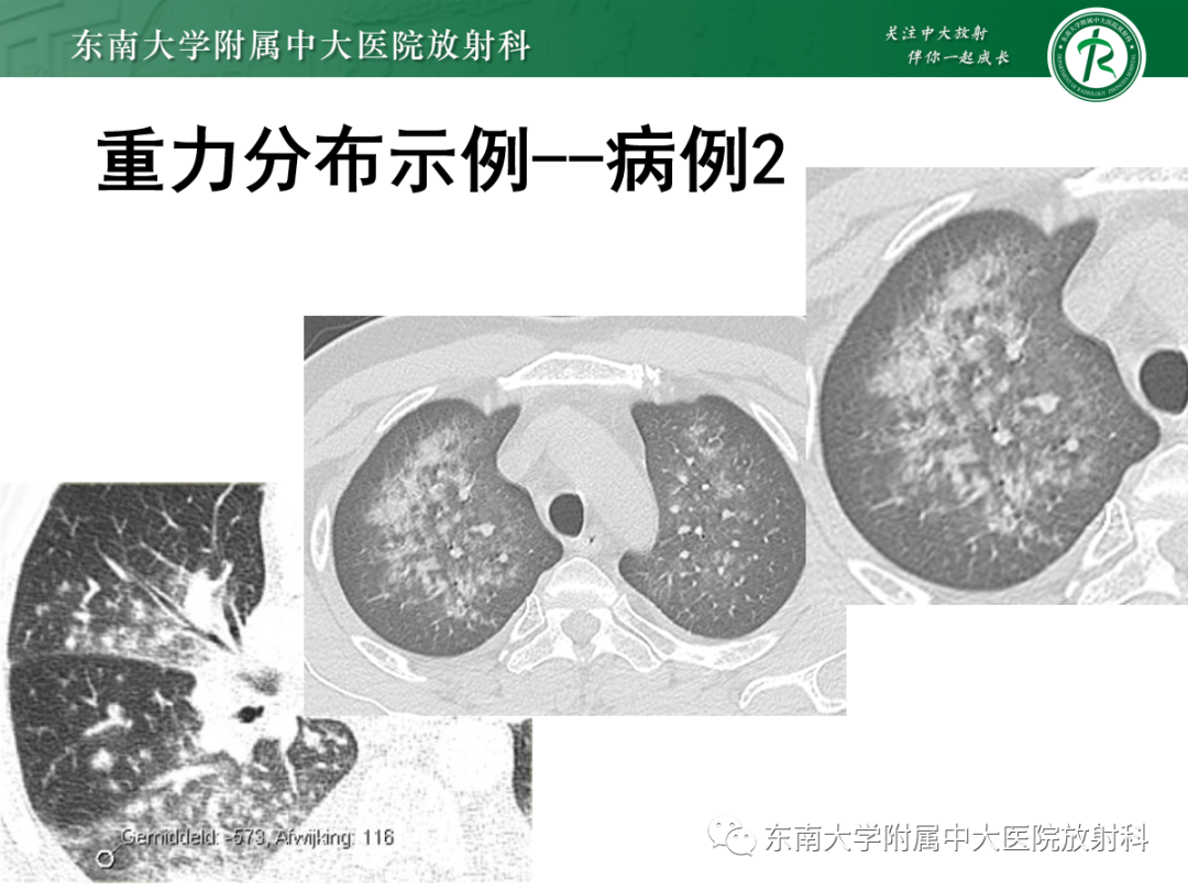 影像PPT - 【PPT】蝶翼征—耶氏肺孢子菌肺炎 VS 急性心源性肺水肿-15 影像PPT - 【PPT】蝶翼征—耶氏肺孢子菌肺炎 VS 急性心源性肺水肿-15