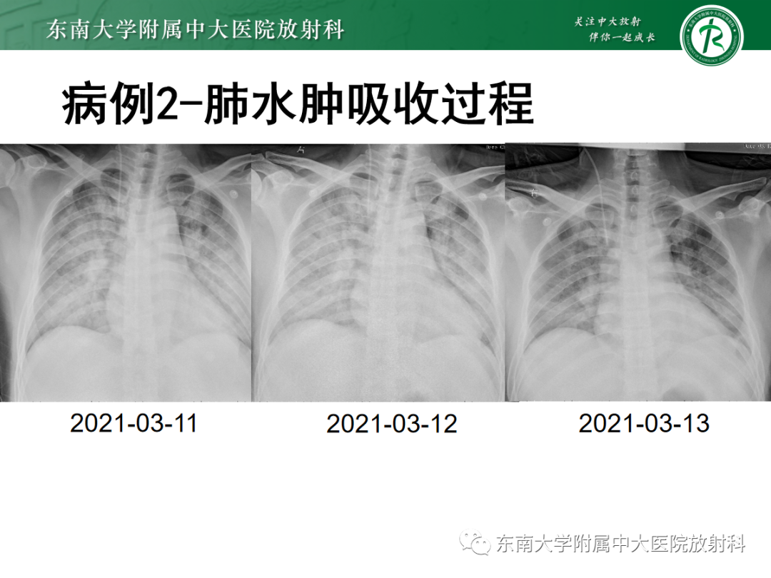 影像PPT - 【PPT】蝶翼征—耶氏肺孢子菌肺炎 VS 急性心源性肺水肿-16 影像PPT - 【PPT】蝶翼征—耶氏肺孢子菌肺炎 VS 急性心源性肺水肿-16