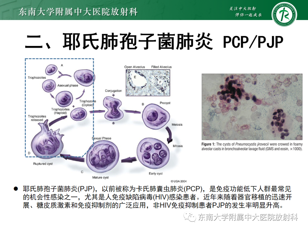 影像PPT - 【PPT】蝶翼征—耶氏肺孢子菌肺炎 VS 急性心源性肺水肿-20 影像PPT - 【PPT】蝶翼征—耶氏肺孢子菌肺炎 VS 急性心源性肺水肿-20
