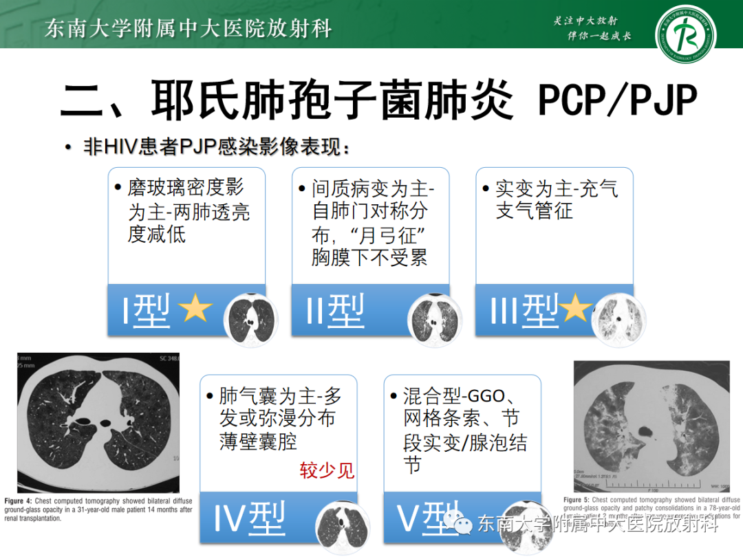 影像PPT - 【PPT】蝶翼征—耶氏肺孢子菌肺炎 VS 急性心源性肺水肿-22 影像PPT - 【PPT】蝶翼征—耶氏肺孢子菌肺炎 VS 急性心源性肺水肿-22